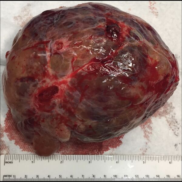 File:Gastrointestinal stromal tumor (gross pathology) (Radiopaedia 77579).jpeg