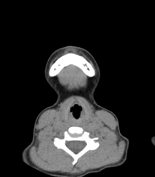 File:Nasoorbitoethmoid fracture (Radiopaedia 90044-107205 Axial non-contrast 29).jpg