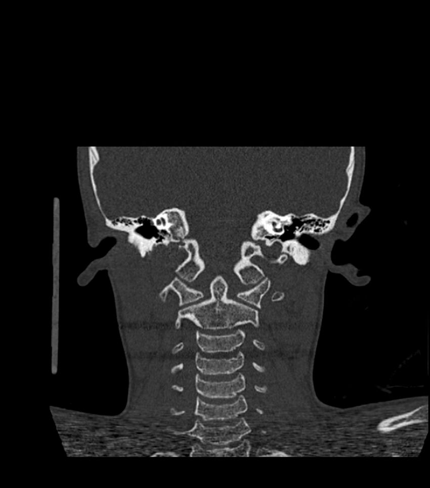 Nasoorbitoethmoid fracture (Radiopaedia 90044-107205 Coronal bone window 103).jpg