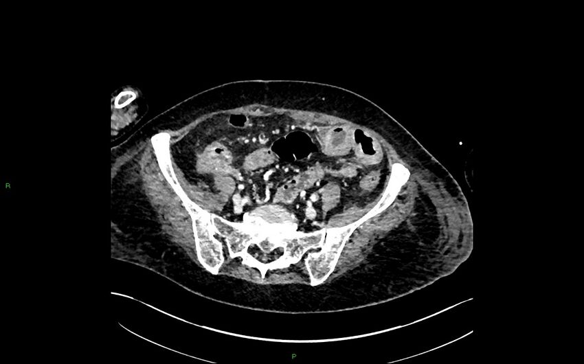 Neo-terminal ileal stricture (Crohn disease) (Radiopaedia 33790-34948 A 348).jpg