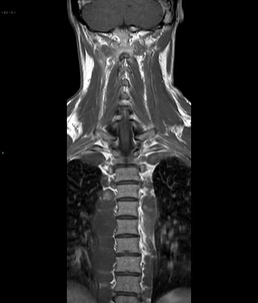 File:Neurofibromatosis type 1 (Radiopaedia 36933-38560 Coronal T1 14).jpg
