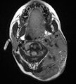 Neurofibromatosis type 1 (Radiopaedia 6954-8063 Axial FLAIR 2).jpg