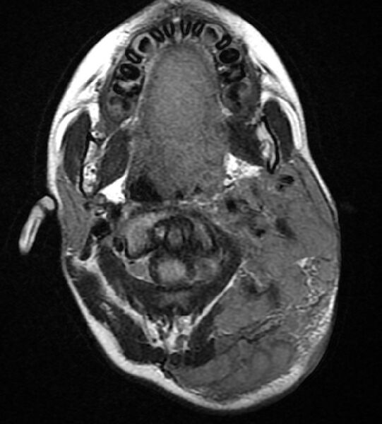 File:Neurofibromatosis type 1 (Radiopaedia 6954-8063 Axial FLAIR 2).jpg