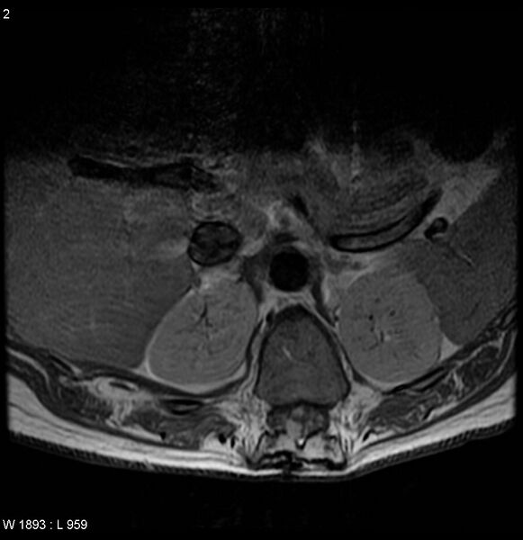 File:Neurofibromatosis type 2 - cranial and spinal involvement (Radiopaedia 5351-7112 Axial T1 C+ 2).jpg