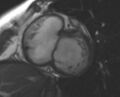 Non-compaction of the left ventricle (Radiopaedia 69436-79314 Short axis cine 177).jpg