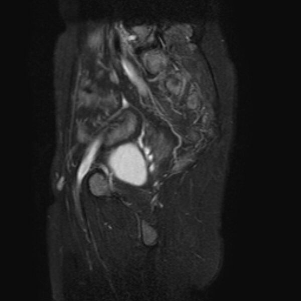 File:Non-puerperal uterine inversion (Radiopaedia 78343-90983 Sagittal T2 fat sat 5).jpg