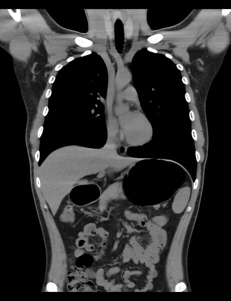 File:Normal CT virtual gastroscopy (Radiopaedia 29960-30501 E 11).jpg