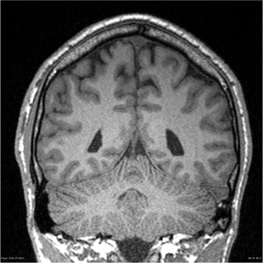 Normal brain MRI (non-focal epilepsy protocol) (Radiopaedia 38571-40700 Coronal T1 35).jpg