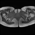 Normal female pelvis MRI (retroverted uterus) (Radiopaedia 61832-69933 Axial T1 29).jpg