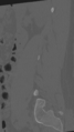 Normal lumbar spine CT (Radiopaedia 46533-50986 Sagittal bone window 23).png