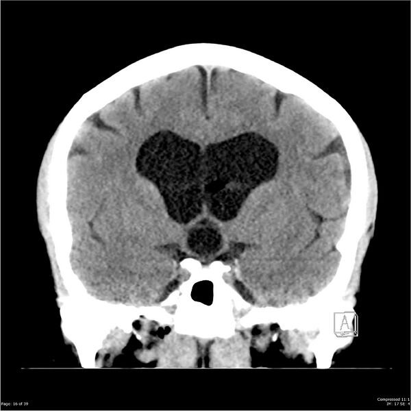File:Normal pressure hydrocephalus (Radiopaedia 24415-24736 Coronal non-contrast 12).jpg