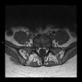 Normal spine MRI (Radiopaedia 77323-89408 Axial T1 24).jpg