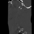 Normal trauma cervical spine (Radiopaedia 41017-43760 Sagittal bone window 3).png