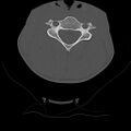 Normal trauma spine imaging (age 16) (Radiopaedia 45335-49358 Axial bone window 38).jpg