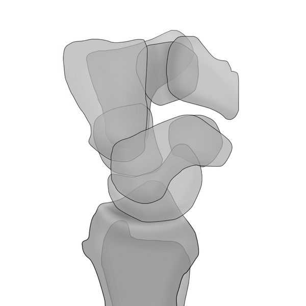 File:Normal wrist alignment, dorsal and volar intercalated segmental instability (illustration) (Radiopaedia 80949-94489 A 2).png