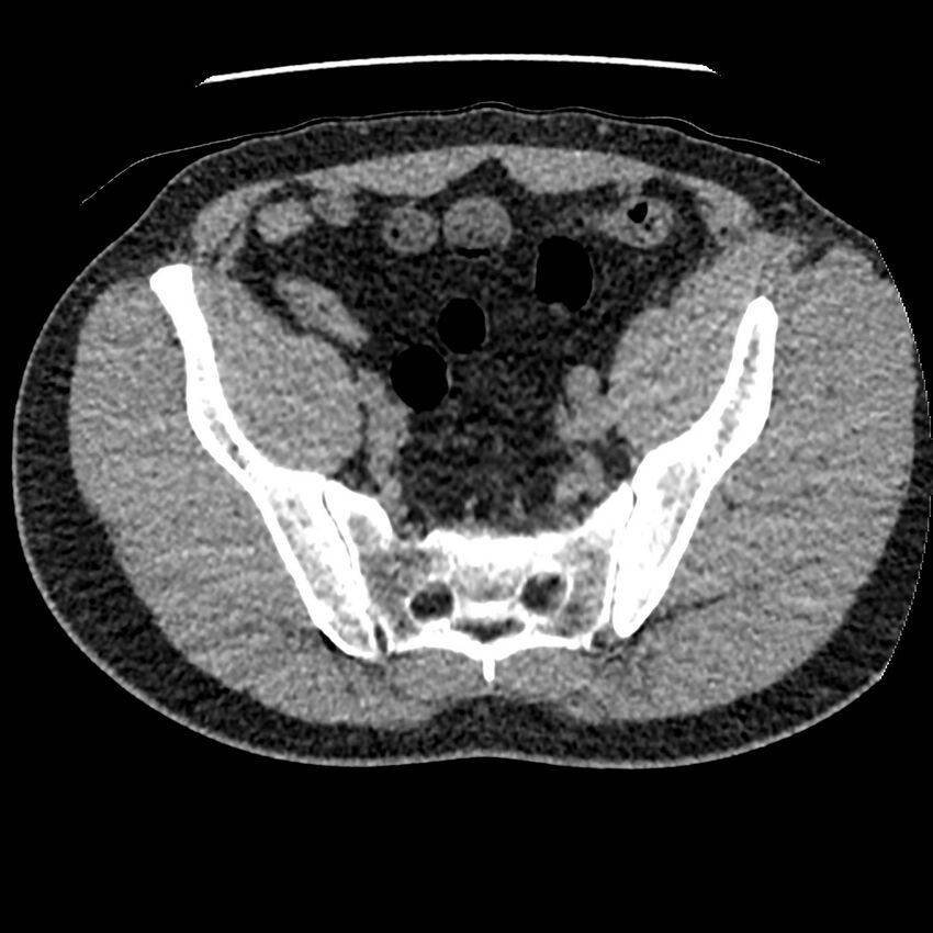 Obstructing ureteric calculus and ureteric anatomy (Radiopaedia 62730-71042 Axial non-contrast 129).jpg