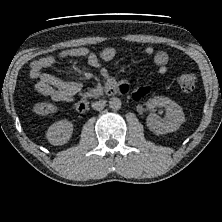 Obstructing ureteric calculus and ureteric anatomy (Radiopaedia 62730-71042 Axial non-contrast 48).jpg