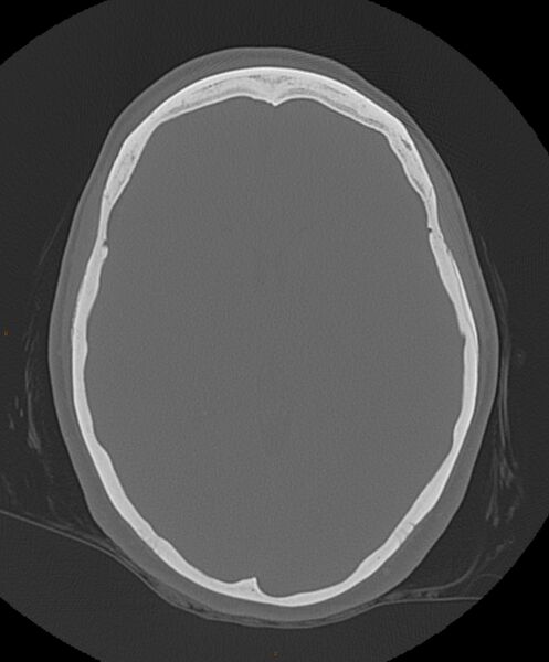 File:Occipital condyle fracture (Radiopaedia 61165-69056 Axial bone window 11).jpg