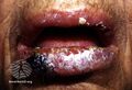 Oral pemphigus vulgaris (DermNet NZ immune-pgus2).jpg