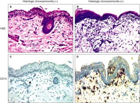 a,c)Epidermis and dermis do not show significant changes in a fetus without histological chorioamnionitis b,d) inflammatory infiltrate is evident in the epidermis and dermis of a fetus with histological chorioamnionitis