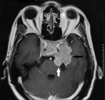 Invasive prolactinoma showing invasion into the left temporal lobe