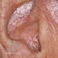 Psoriasis (DermNet NZ dermatitis-s-otitis5).jpg
