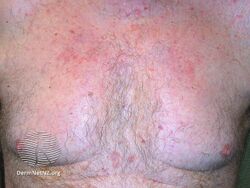 Seborrhoeic dermatitis chest