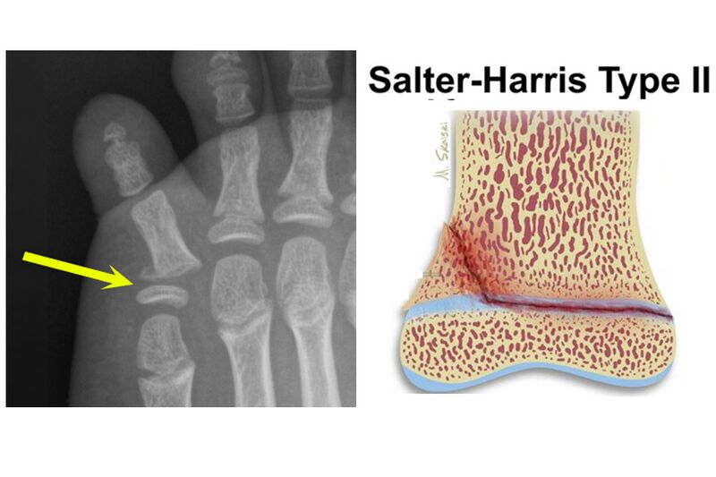 File:5th toe fracture - Salter-Harris type II (Radiopaedia 67151-76492 annotated image 1).jpg