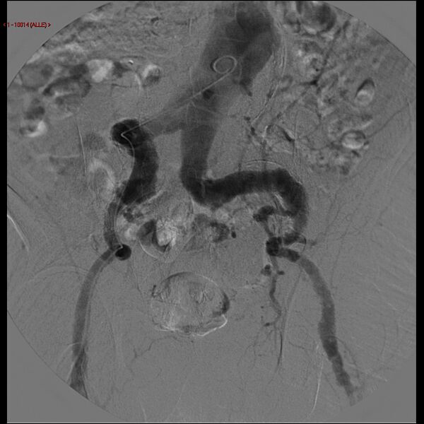 File:Abdominal aortic aneurysm (Radiopaedia 16155-15833 Frontal Aorta 10).jpg