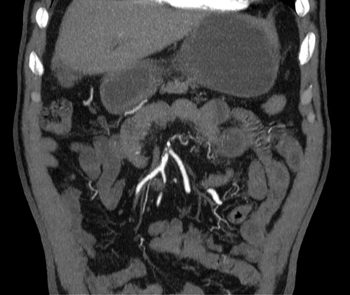 File:Abdominal aortic aneurysm (Radiopaedia 22421-22458 C 6).jpg