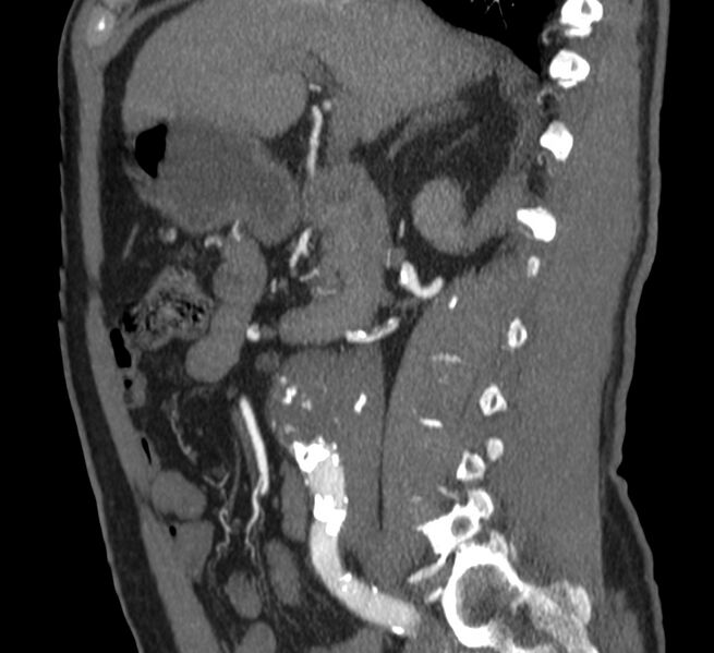 File:Abdominal aortic aneurysm (Radiopaedia 22421-22458 D 13).jpg