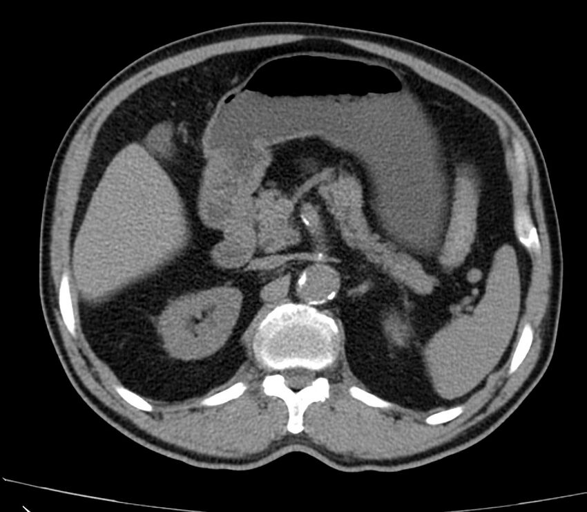 Abdominal aortic aneurysm (Radiopaedia 22421-22458 non-contrast 17).jpg