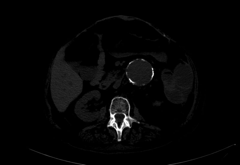 File:Abdominal aortic aneurysm - impending rupture (Radiopaedia 19233-19246 B 10).jpg