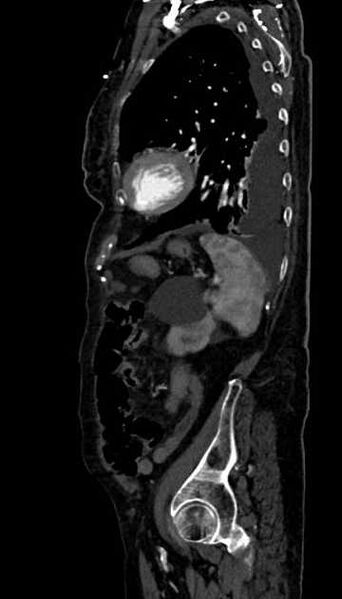 File:Abdominal aortic aneurysm with thrombus fissuration (Radiopaedia 73192-83919 Sagittal C+ arterial phase 27).jpg