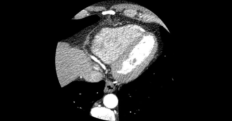 File:Aberrant left main coronary artery (ALMCA) arising from the right sinus with interarterial course (Radiopaedia 63251-71814 Axial C+ arterial phase 165).JPG