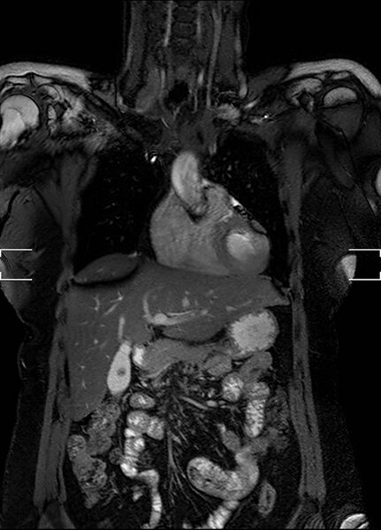 File:Aberrant right subclavian artery with background Takayasu arteritis (Radiopaedia 21423-21363 Coronal MRA 2).jpg
