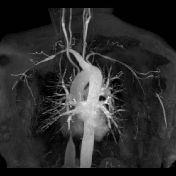 File:Aberrant right subclavian artery with background Takayasu arteritis (Radiopaedia 21423-21363 MRA 4).jpg