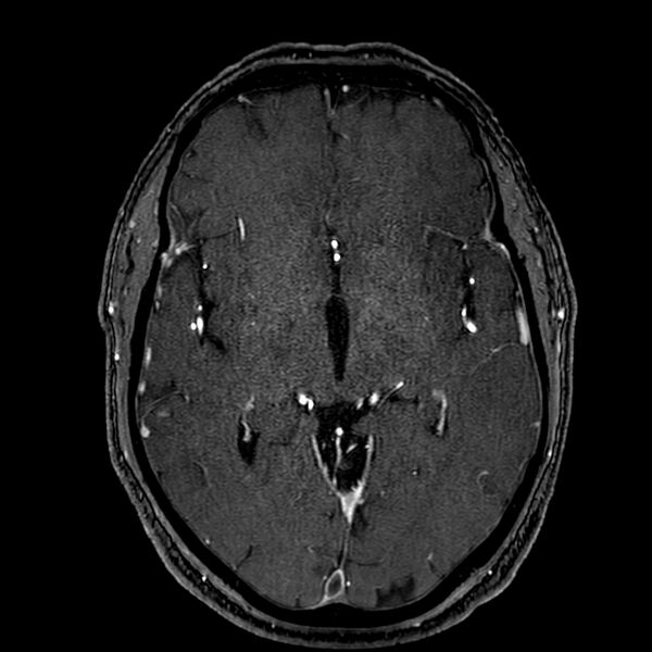 File:Accessory middle cerebral artery (Radiopaedia 73114-83828 Axial MRA 93).jpg