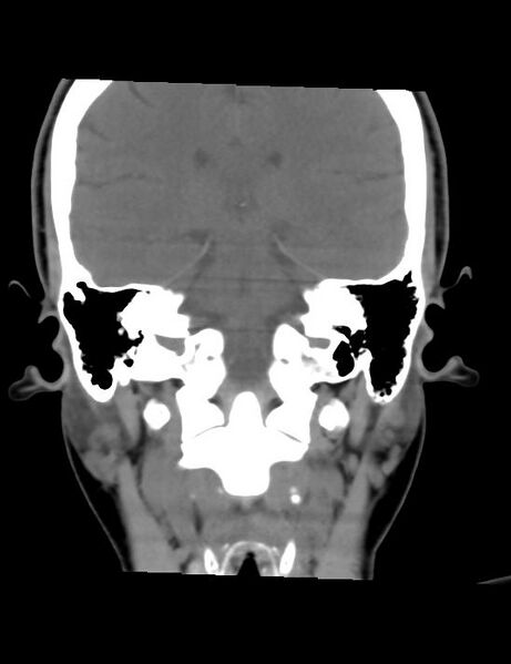 File:Accessory parotid glands (Radiopaedia 27289-27472 Coronal non-contrast 3).jpg