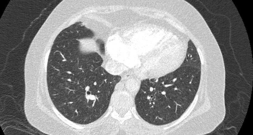 Accessory right inferior hepatic vein (Radiopaedia 65245-74259 Axial lung window 54).jpg
