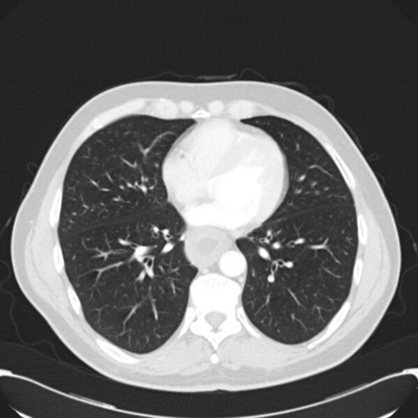 File:Achalasia (Radiopaedia 24937-25206 Axial lung window 22).jpg