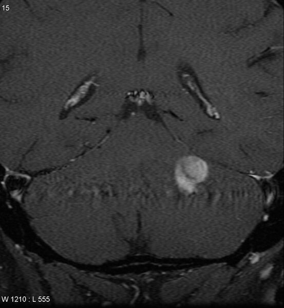 File:Acoustic schwannoma (large with cystic change) (Radiopaedia 5369-7130 Coronal T1 C+ fat sat 12).jpg