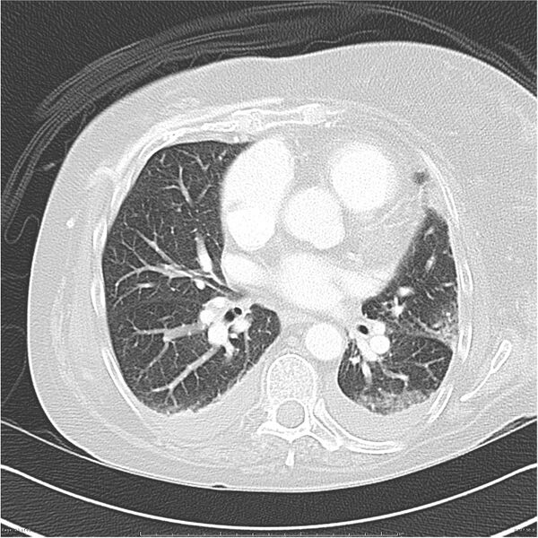 File:Acute-on-chronic pulmonary emboli (Radiopaedia 27925-28169 lung window 27).jpg