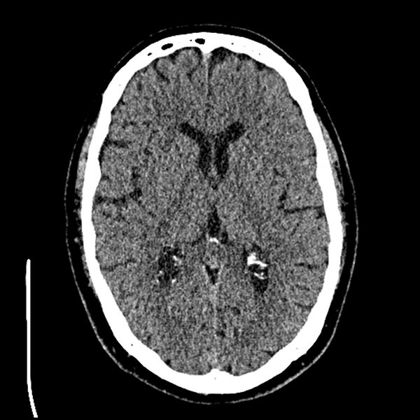 File:Acute A3 occlusion with ACA ischemic penumbra (CT perfusion) (Radiopaedia 72036-82525 Axial non-contrast thins 37).jpg