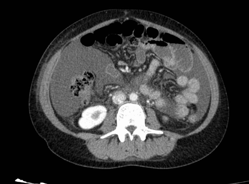 Acute Budd-Chiari syndrome (Radiopaedia 60858-68638 Axial C+ portal venous phase 161).jpg
