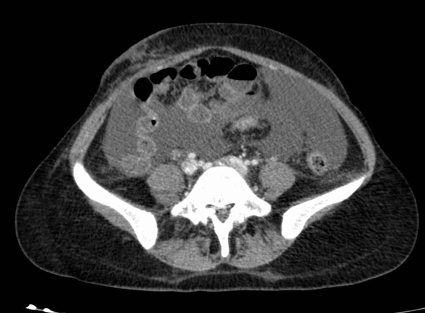 Acute Budd-Chiari syndrome (Radiopaedia 60858-68638 Axial C+ portal venous phase 207).jpg