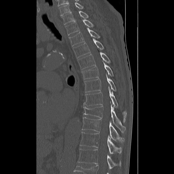 File:Acute and chronic vertebral compression fractures (Radiopaedia 31608-32494 Sagittal bone window 16).jpg