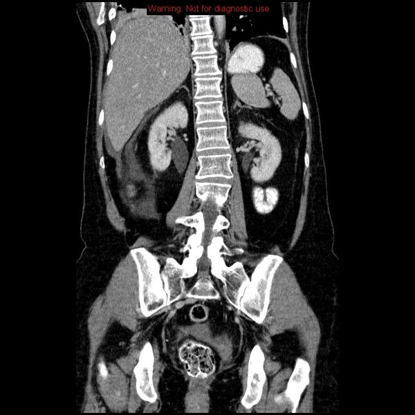File:Acute gangrenous cholecystitis (Radiopaedia 10123-10661 Coronal C+ portal venous phase 31).jpg