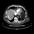 Acute heart failure (CT) (Radiopaedia 79835-93075 Axial C+ arterial phase 51).jpg