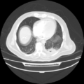 Acute heart failure (CT) (Radiopaedia 79835-93075 Axial lung window 34).png